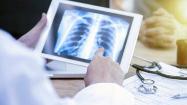 AI Can Match Or Outperform Radiologists In TB Diagnosis, Study Says