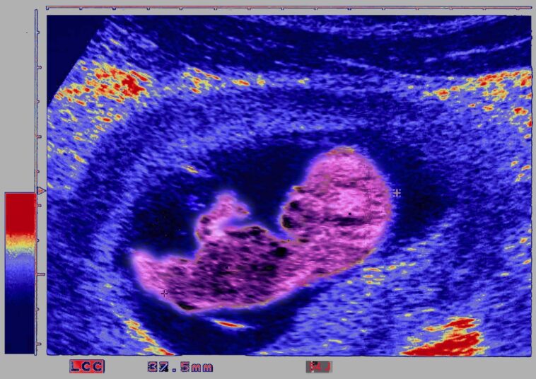 Here Is How AI Is Being Used In Fetal Ultrasounds