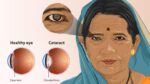 Aravind: An Answer To India’s Cataract Problem