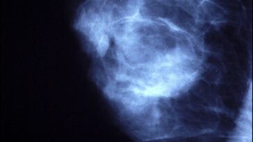 What You Need To Know About Male Breast Cancer