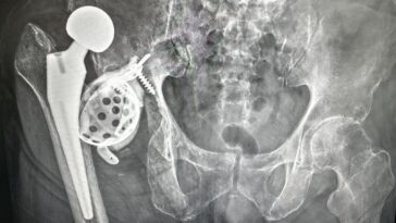 Ignored Failures Of A High-Volume Joint Replacement Society