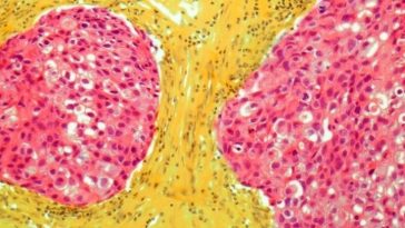 Most Women at High-Risk of Breast Cancer Are Unaware of Preventative Medicines