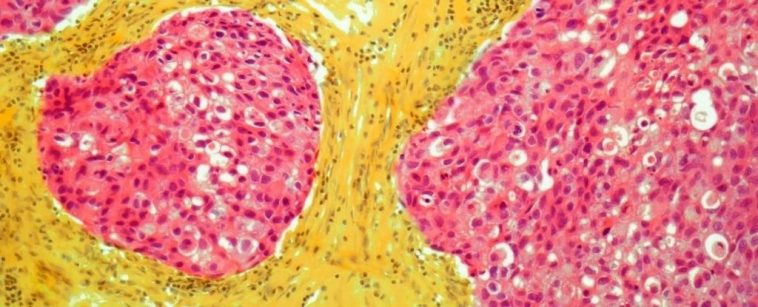 Most Women at High-Risk of Breast Cancer Are Unaware of Preventative Medicines