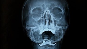 Tiny Channels Discovered Inside The Human Skull Could Be Vital For The Brain