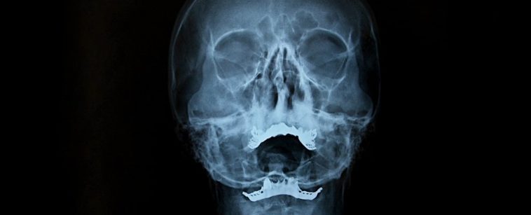 Tiny Channels Discovered Inside The Human Skull Could Be Vital For The Brain Tiny Channels Discovered Inside The Human Skull Could Be Vital For The Brain