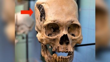 Mysterious Skull Implanted With Strange Metallic Object Divides Experts