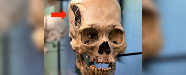 Mysterious Skull Implanted With Strange Metallic Object Divides Experts