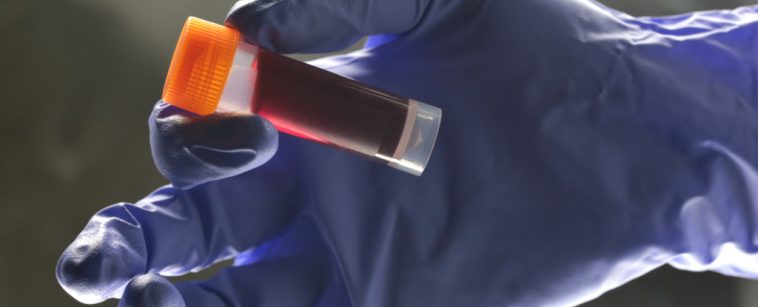 Your Blood Type Affects Your Risk of an Early Stroke, Scientists Find : ScienceAlert