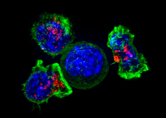 CAR T: Blood Cancer Breakthrough to Solid Tumors